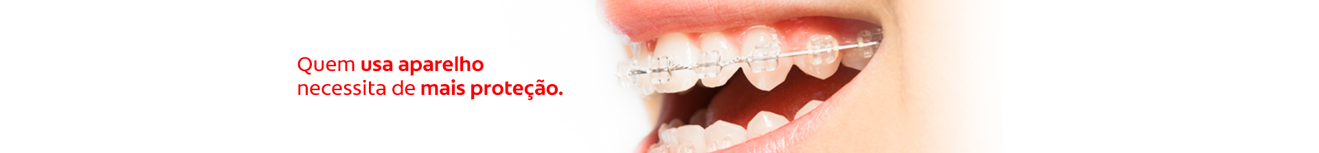 Aparelho Ortodontico | Colgate Profissional